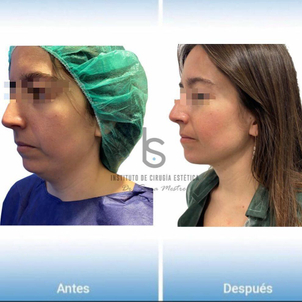 antes y después cirugía de papada