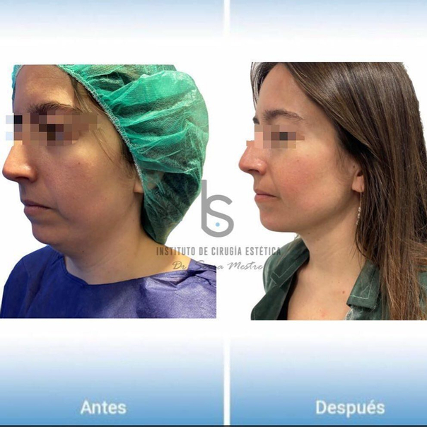 antes y después cirugía de papada