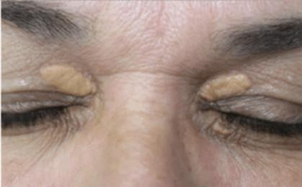 Xantelasmas en los párpados