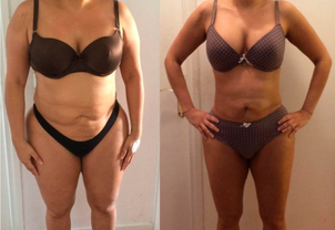 Antes y después del balón gástrico