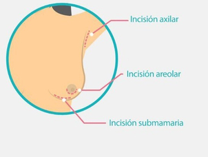 Incisiones aumento mamario