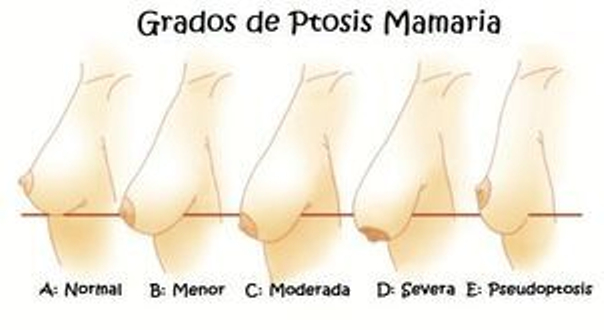 Ilustración de diferentes grados de ptosis mamaria