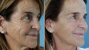 antes y después rejuvenecimiento facial