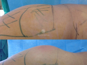 resultado de una Lipo Vaser