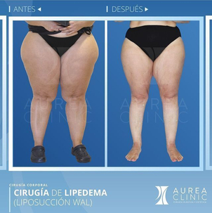 Antes y después liposucción lipedema