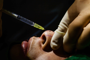 Relleno de nariz con ácido hialurónico