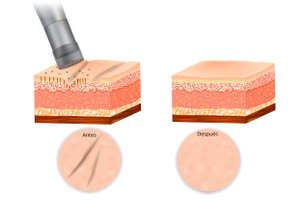 Beneficios del microneedling