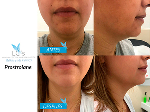 resultados de un lifting sin cirugía