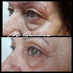 antes y después blefaroplastia sin cirugía