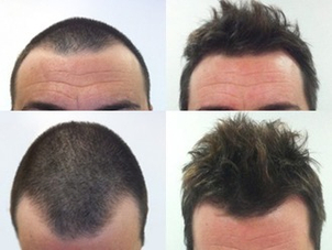 restauración capilar