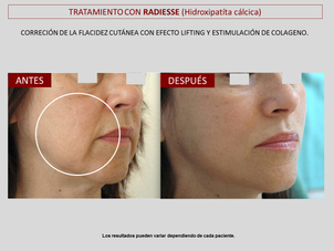 resultados con la tecnica radiesse