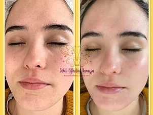 antes y después peeling