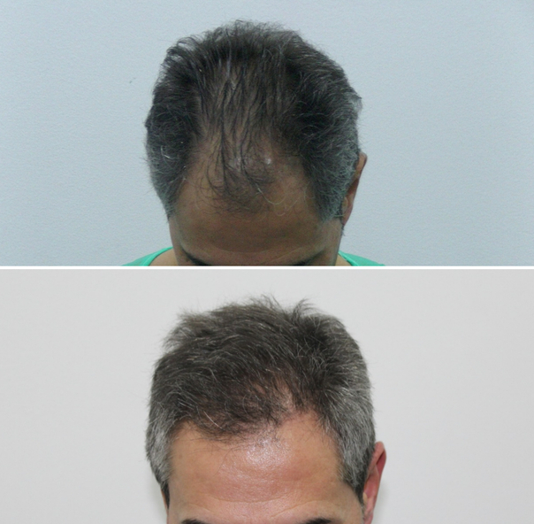 antes y después alopecia