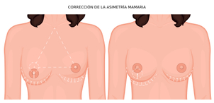 cirugía de asimetría mamaria