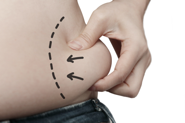 La predisposición genética puede influir en la distribución de la grasa en el cuerpo