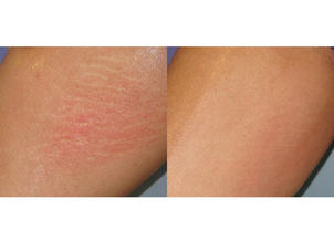 antes y después estrías