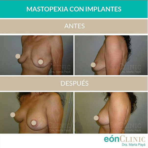 antes y después mastopexia con prótesis