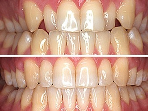 ortodoncia invisible