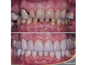 Antes y después de paciente con implantes
