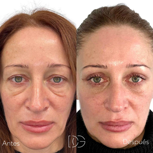 antes y después blefaroplastia