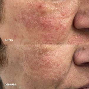 Antes y después del tratamiento de cuperosis