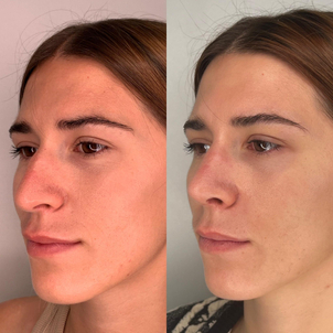 Antes y después de rinoplastia