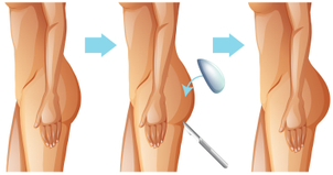 gluteoplastia