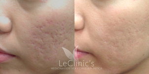 Resultados microneedling