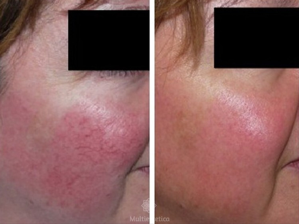 Antes y después del tratamiento de rosácea