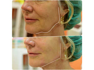 antes y después rejuvenecimiento