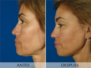 Radiofrecuencia facial