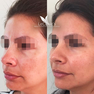 Antes y después de un aumento de pómulos