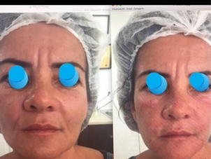 antes y después lifting sin cirugía