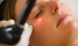 Paso a paso de la blefaroplastia láser Co2