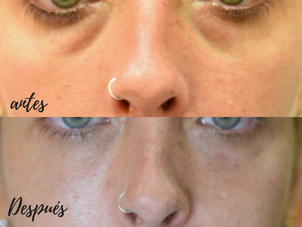 antes y después carboxiterapia