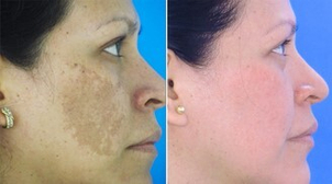 antes y después peeling