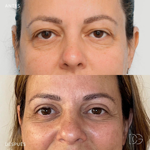 La blefaroplastia