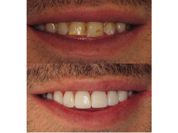 antes y después carillas dentales