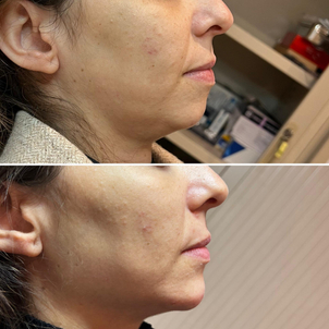 antes y después mentoplasia