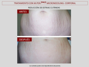 antes y después estrías