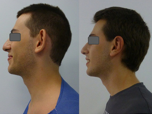 Antes y después de otoplastia