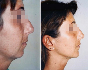 ¿Cómo saber si soy candidato para una lipotransferencia?