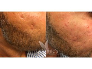 antes y después microneedling