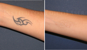 Eliminación tatuajes