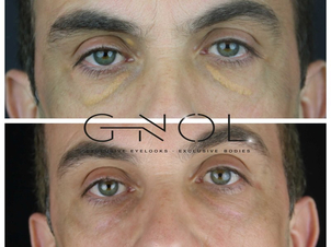 Antes y después del tratamiento de xantalesmas