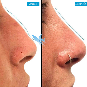 antes y después rinomodelación