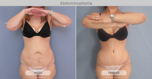 antes y después abdominoplastia