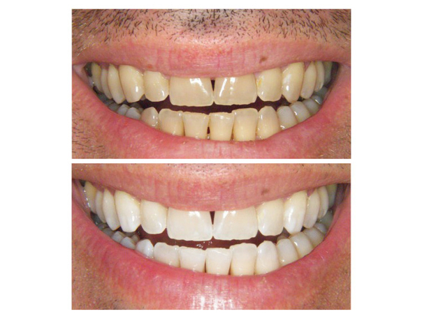 antes y después de blanqueamiento dental