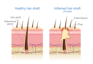 Inflamed hair shaft