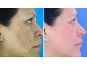 antes y después peeling